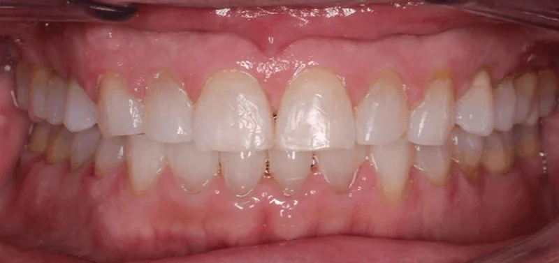 Center Bite - After Treatment