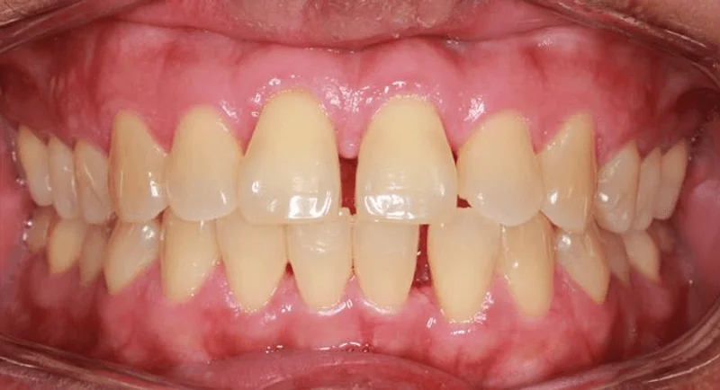 Center Bite - Before Treatment