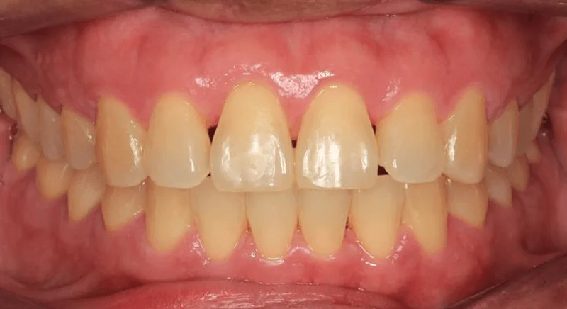 Center Bite - After Treatment