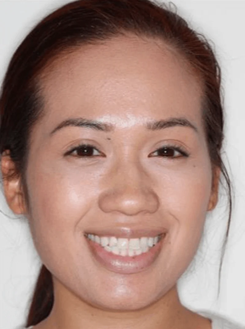 Facial Smiling - Before Treatment