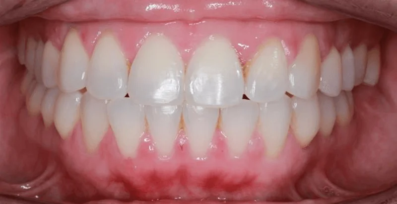 Center Bite - After Treatment