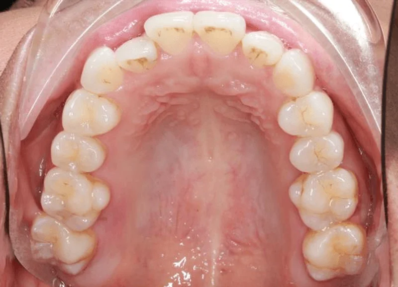 Occlusal Upper - Before Treatment