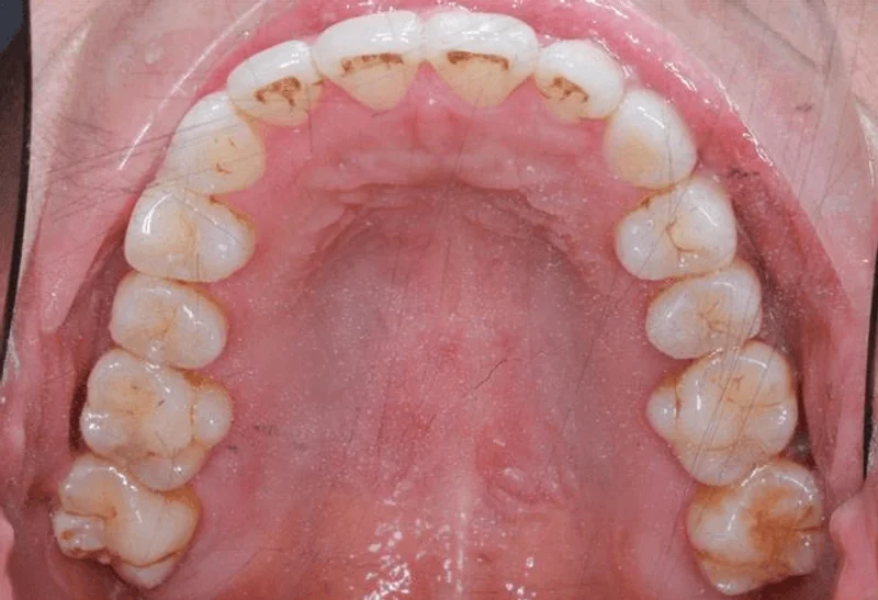 Occlusal Upper - After Treatment