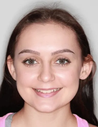 Before Clear Braces treatment - Case 72586