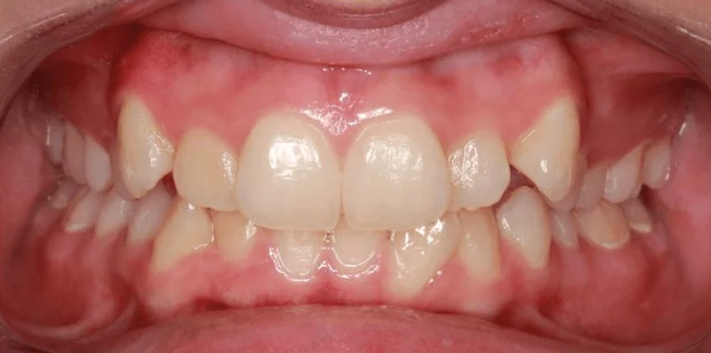 Center Bite - Before Treatment