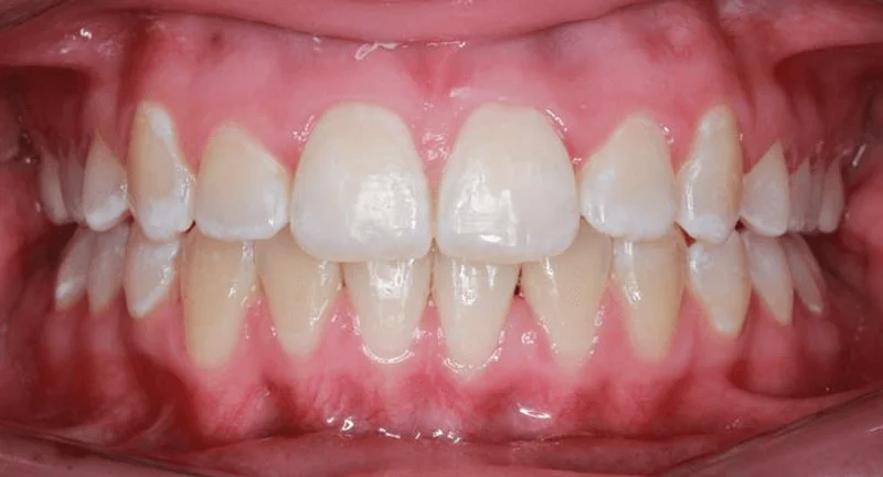 Center Bite - After Treatment
