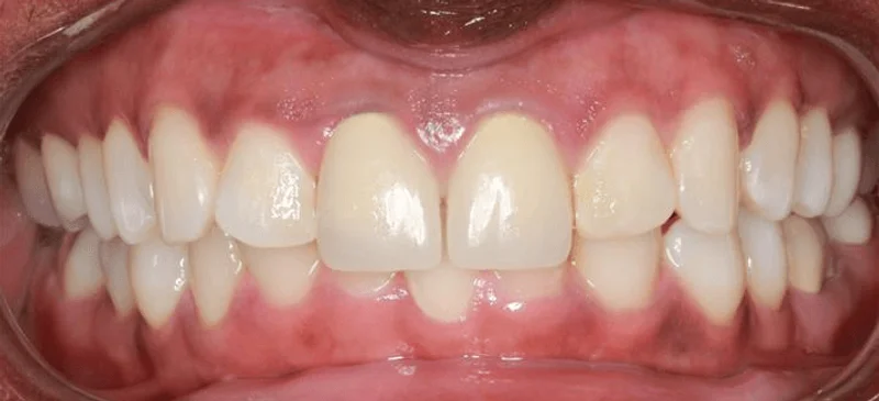 Center Bite - Before Treatment