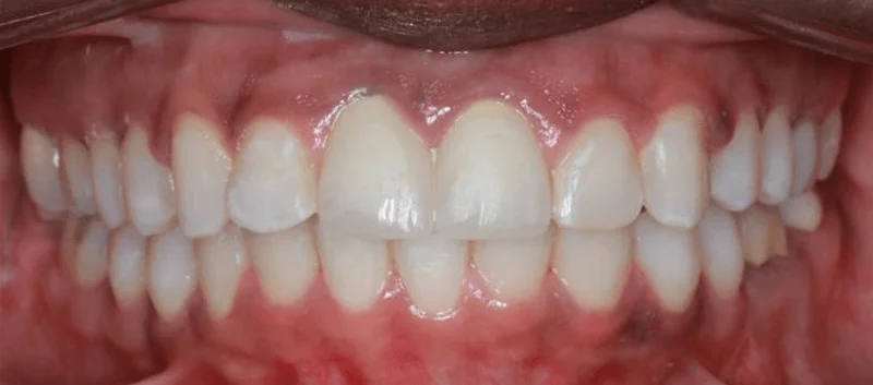 Center Bite - After Treatment