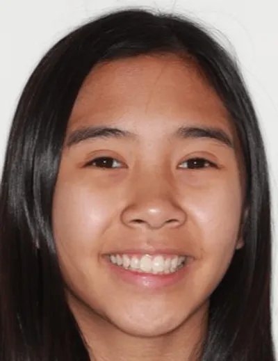 Before Metal Braces treatment - Case 72591