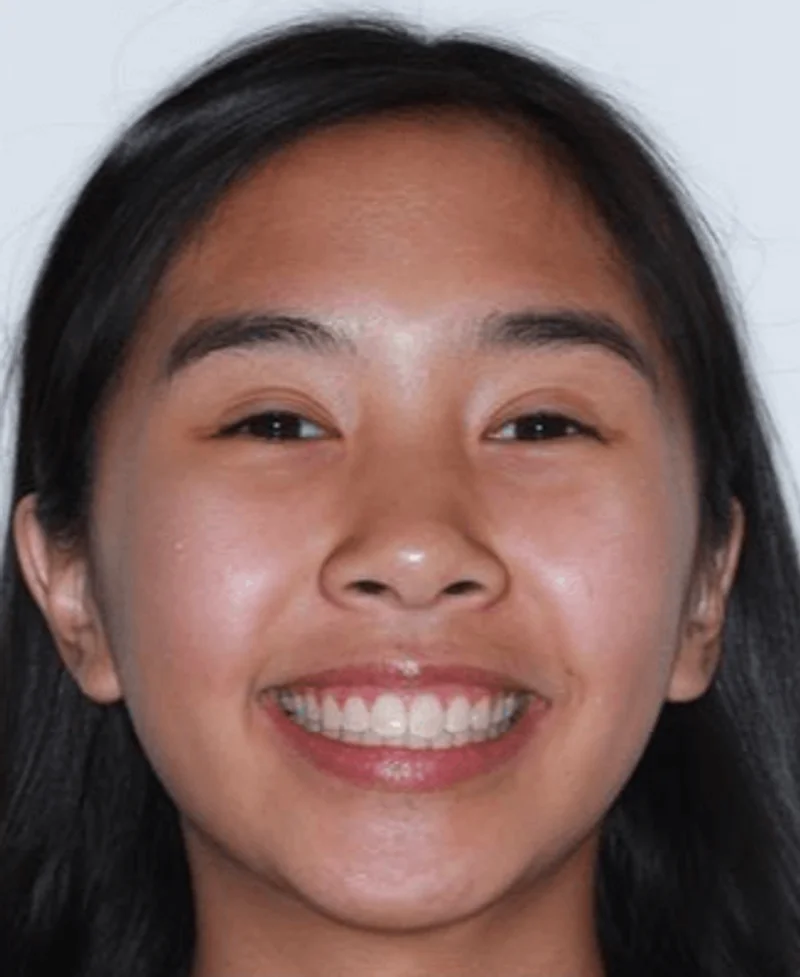 Facial Smiling - After Treatment