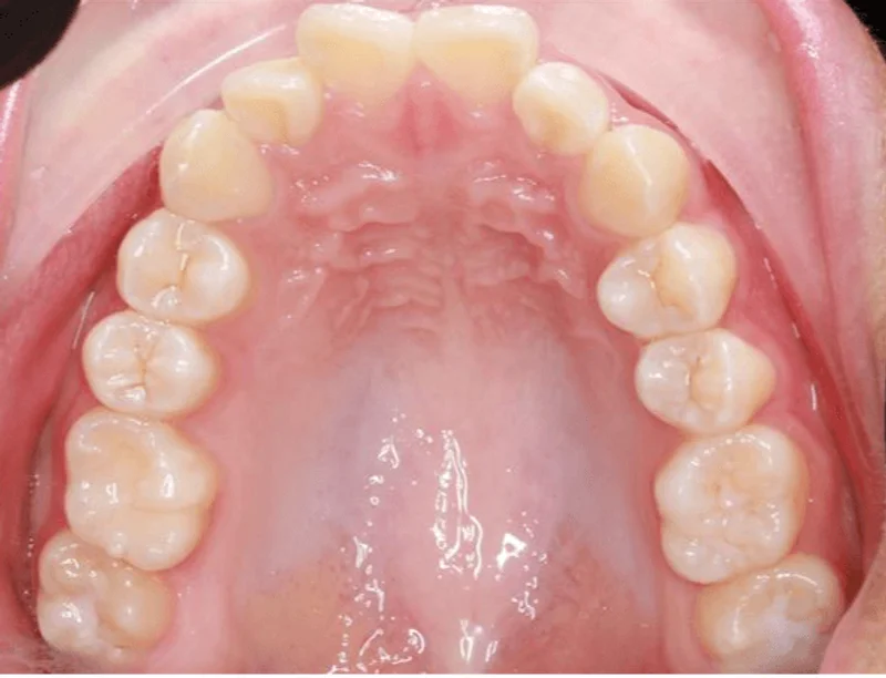 Upper Occlusal - Before Treatment