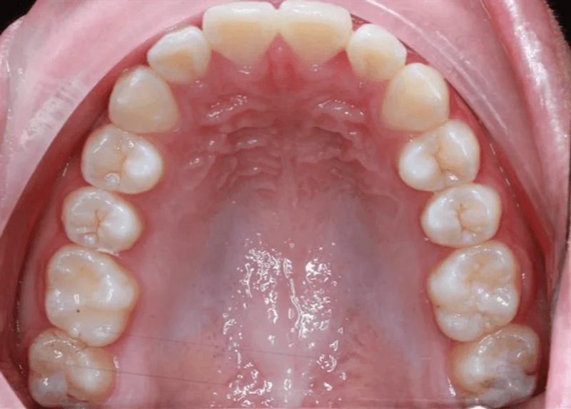 Upper Occlusal - After Treatment
