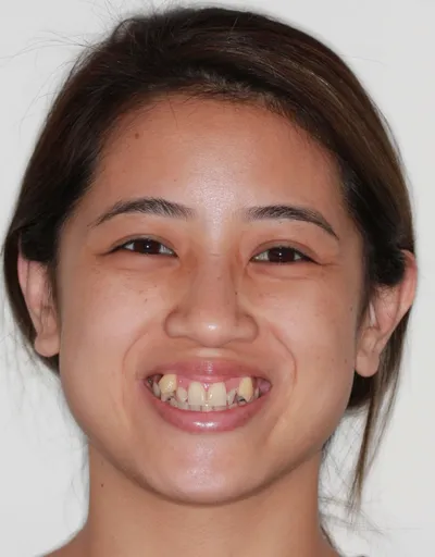 Before Metal Braces treatment - Case 72600