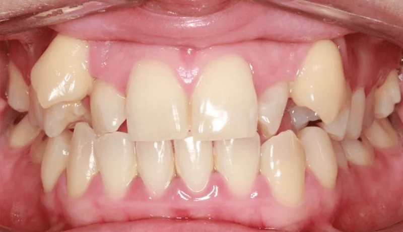 Center Bite - Before Treatment
