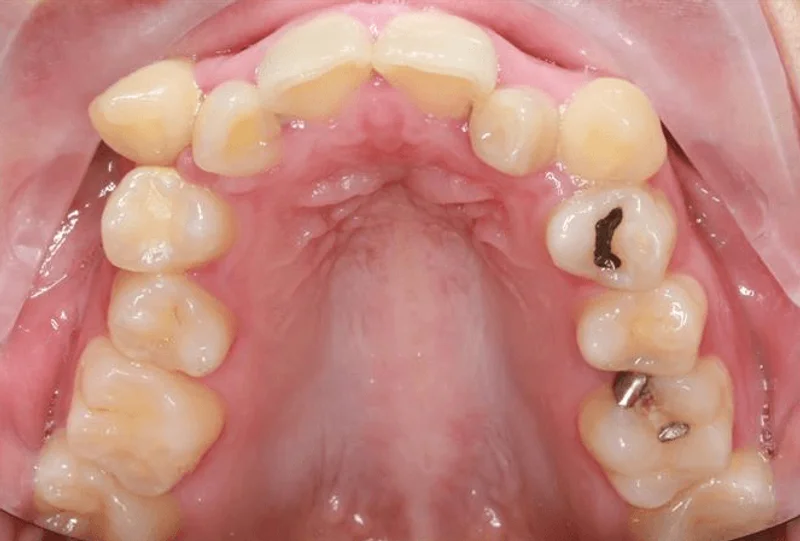 Upper Occlusal - Before Treatment