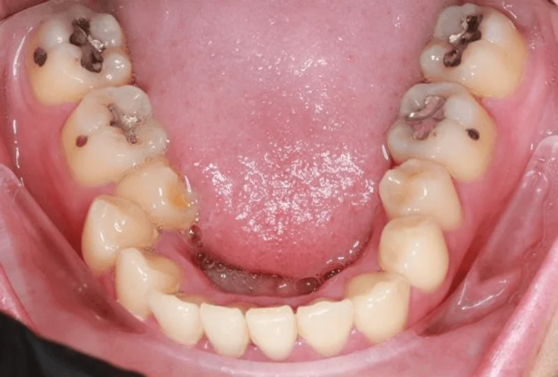 Lower Occlusal - Before Treatment