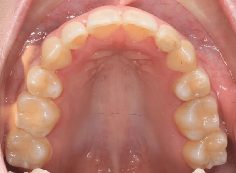Upper Occlusal - After Treatment