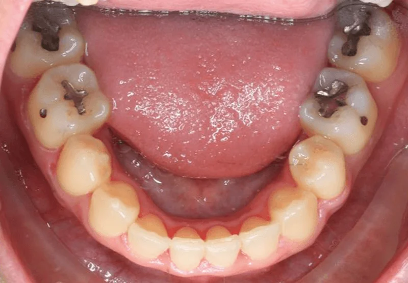 Lower Occlusal - After Treatment