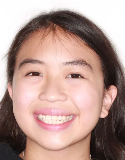 Before Metal Braces treatment - Case 72701