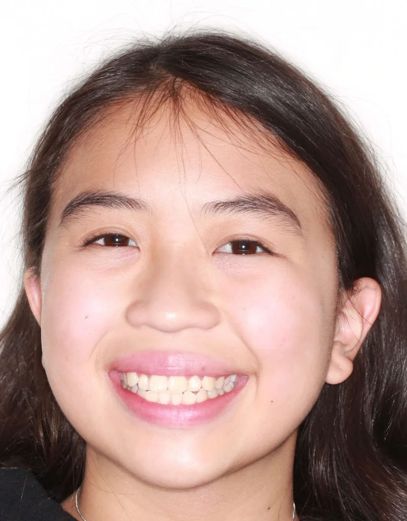 Facial Smiling - Before Treatment