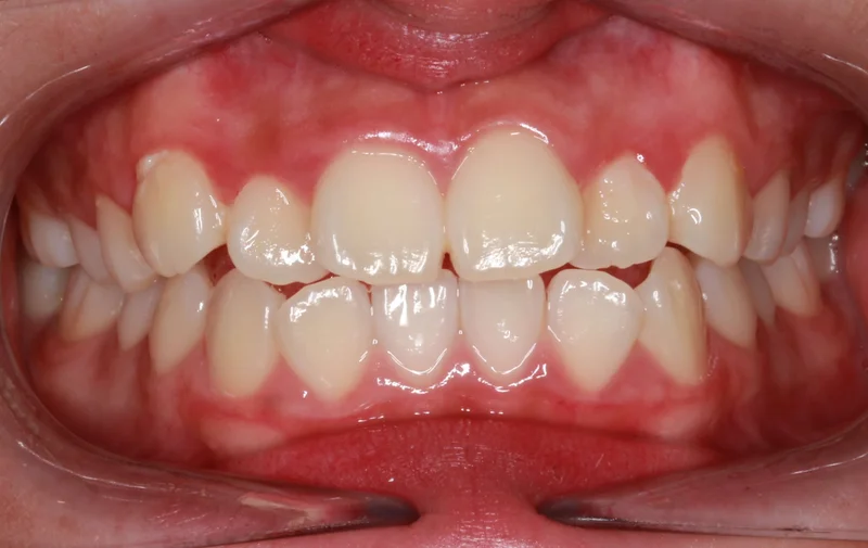 Center Bite - Before Treatment