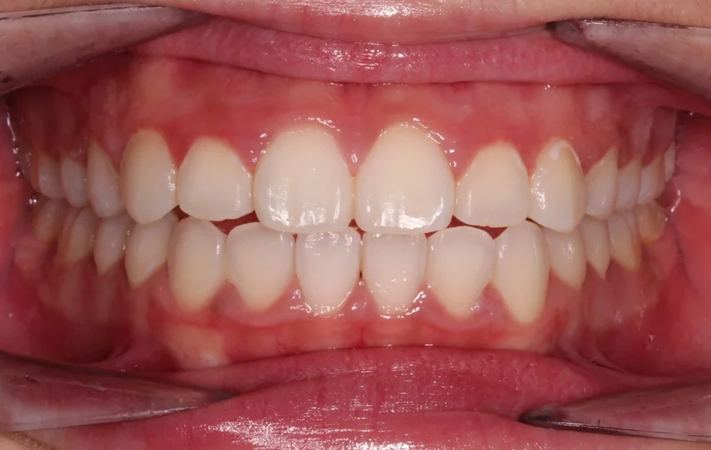 Center Bite - After Treatment
