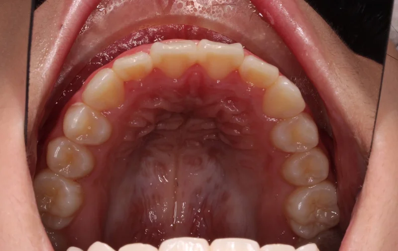 Upper - After Treatment