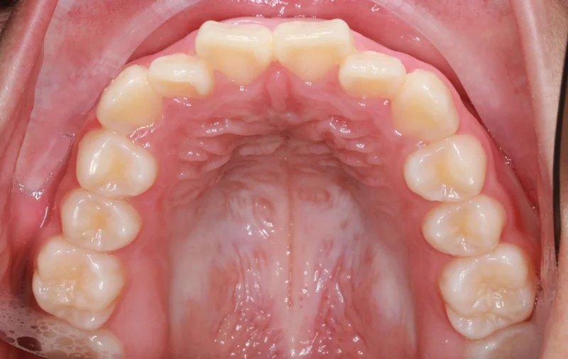 Upper - Before Treatment