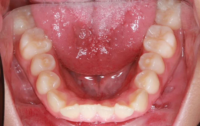 Lower - Before Treatment