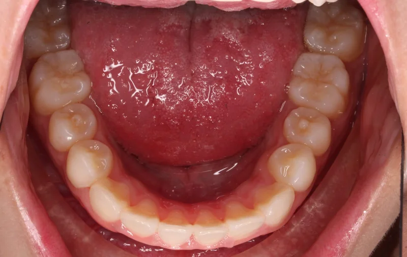 Lower - After Treatment