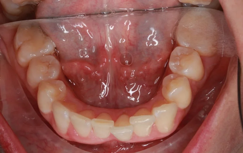 Lower - Before Treatment