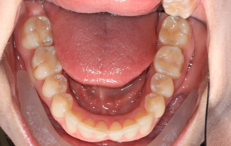 Lower - After Treatment