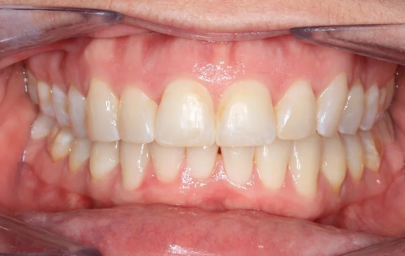 Center Bite - After Treatment
