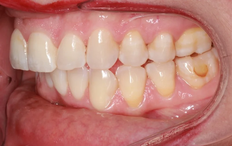 Left Side Bite - Before Treatment