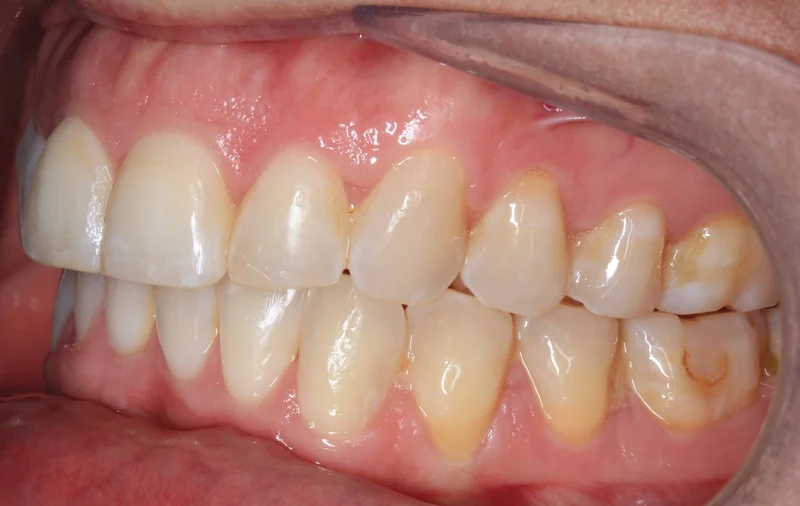 Left Side Bite - After Treatment