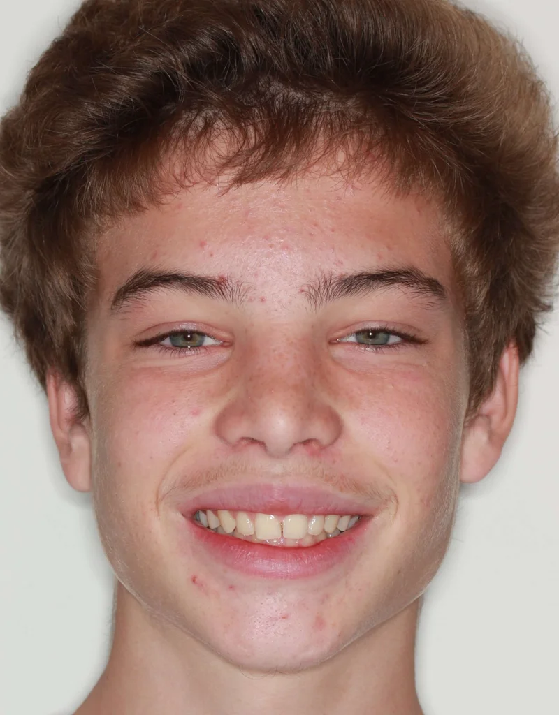 Facial Smiling - Before Treatment