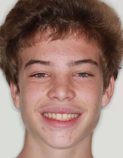 Before Metal Braces treatment - Case 74376