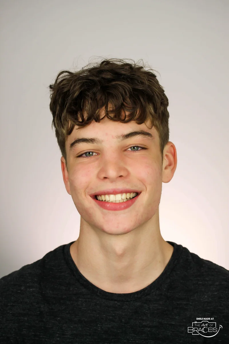 Facial Smiling - After Treatment