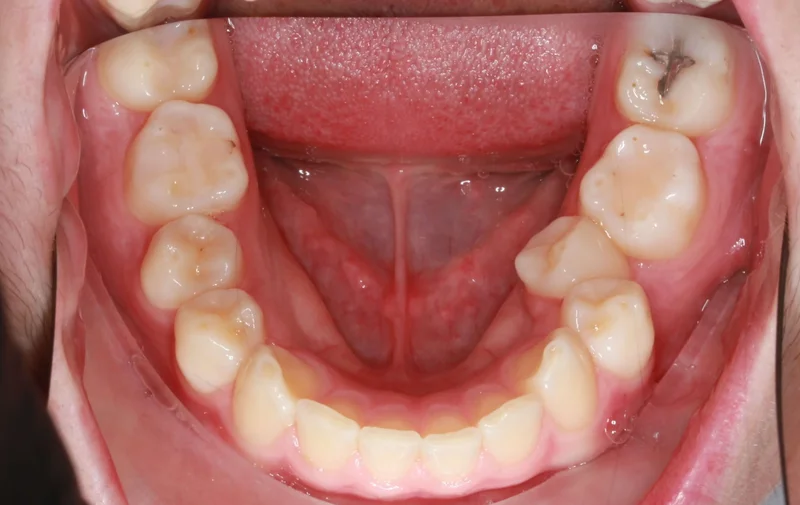 Lower Arch - Before Treatment
