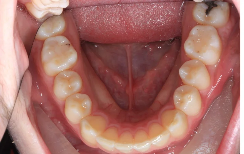 Lower Arch - After Treatment