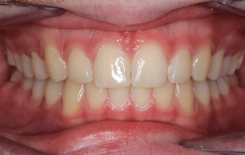 Center Bite - After Treatment