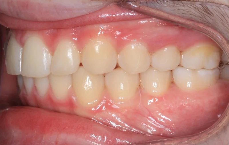 Left Side Bite - After Treatment