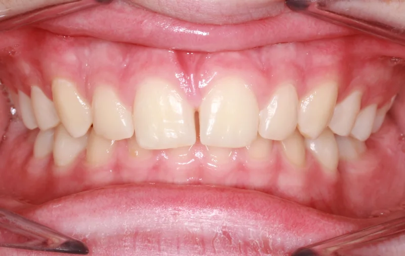 Center Bite - Before Treatment