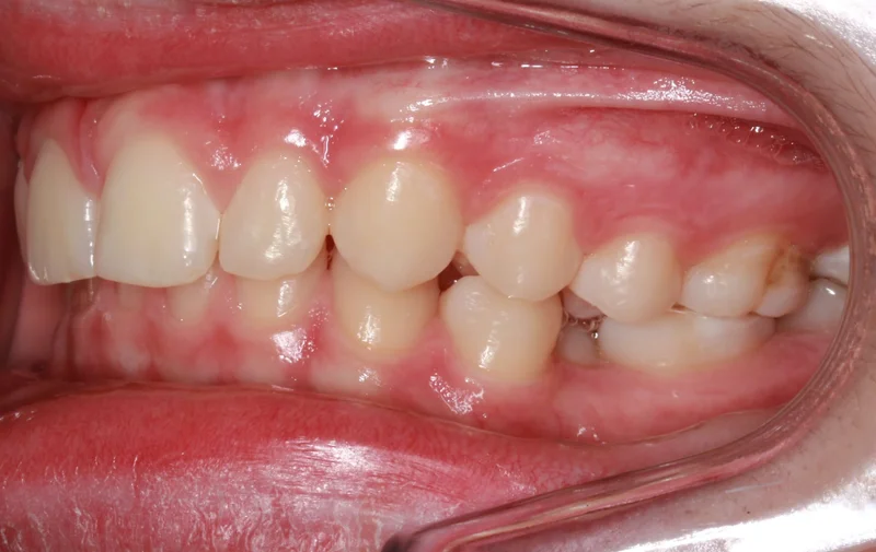 Left Side Bite - Before Treatment