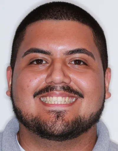 Before Metal Braces treatment - Case 74377