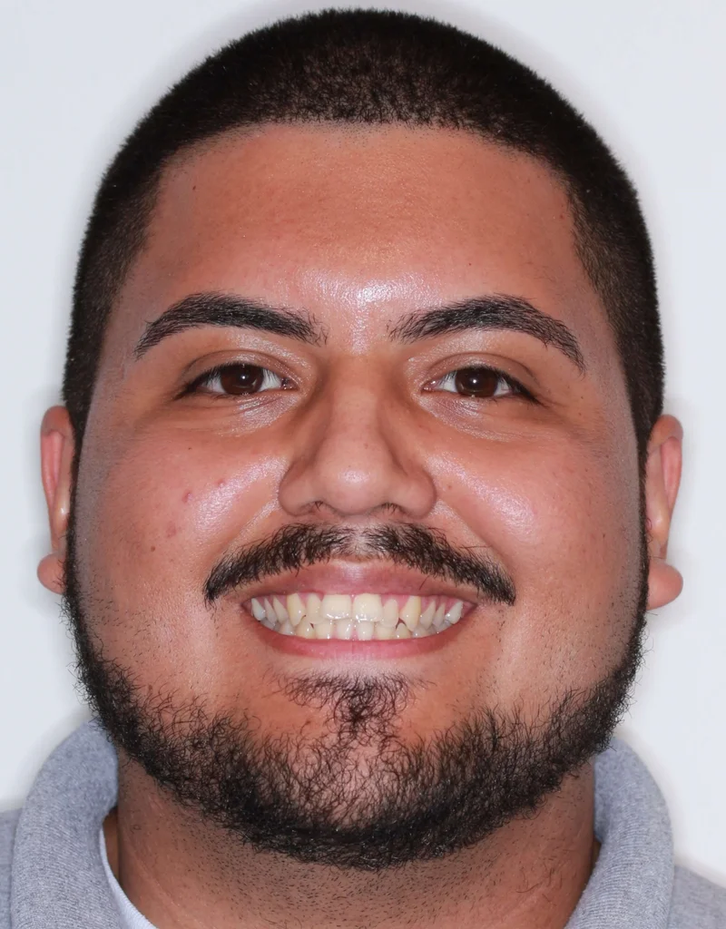 Facial Smiling - Before Treatment