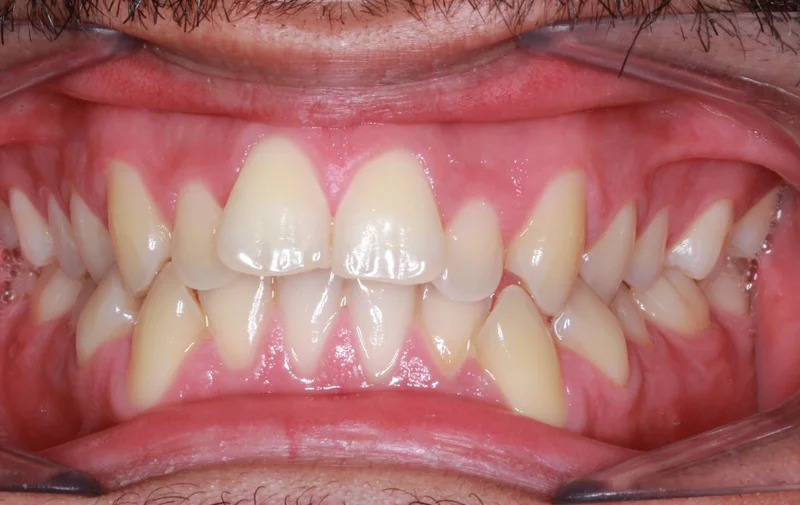 Center Bite - Before Treatment