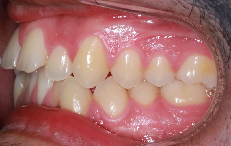 Left Side Bite - Before Treatment