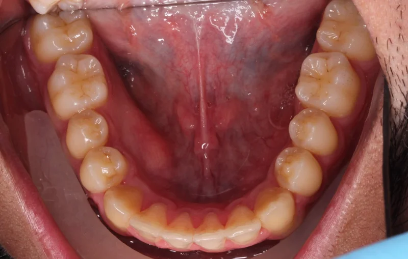 Lower Arch - After Treatment