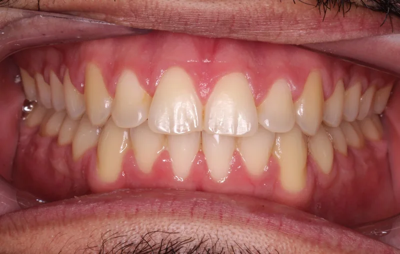 Center Bite - After Treatment
